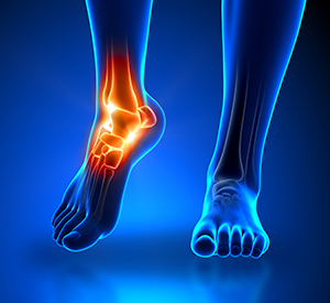 Heel Pain Center Chesterfield MI - Premier Foot & Ankle - ankle_pain