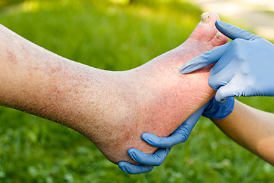 Heel Pain Center Clinton Township MI - Premier Foot & Ankle - ingrown_toenails